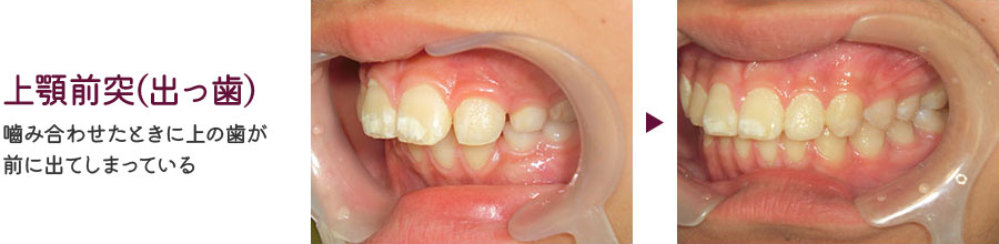 上顎前突(出っ歯)