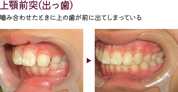 上顎前突(出っ歯)