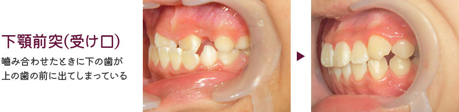 上顎前突(出っ歯)