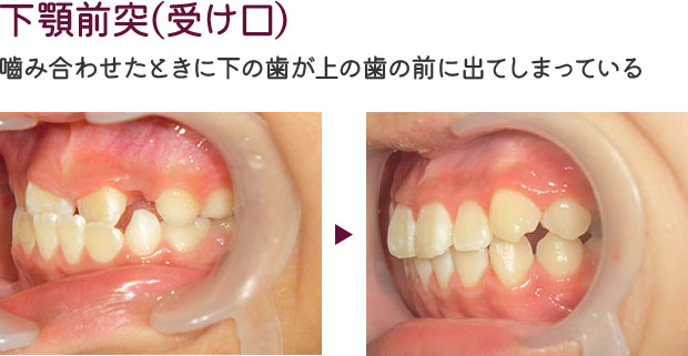 上顎前突(出っ歯)
