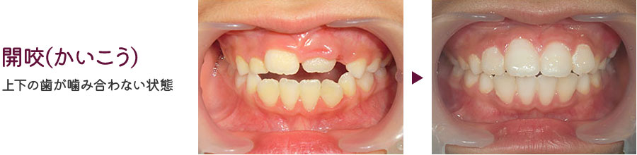 上顎前突(出っ歯)