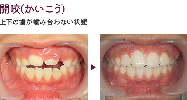 上顎前突(出っ歯)
