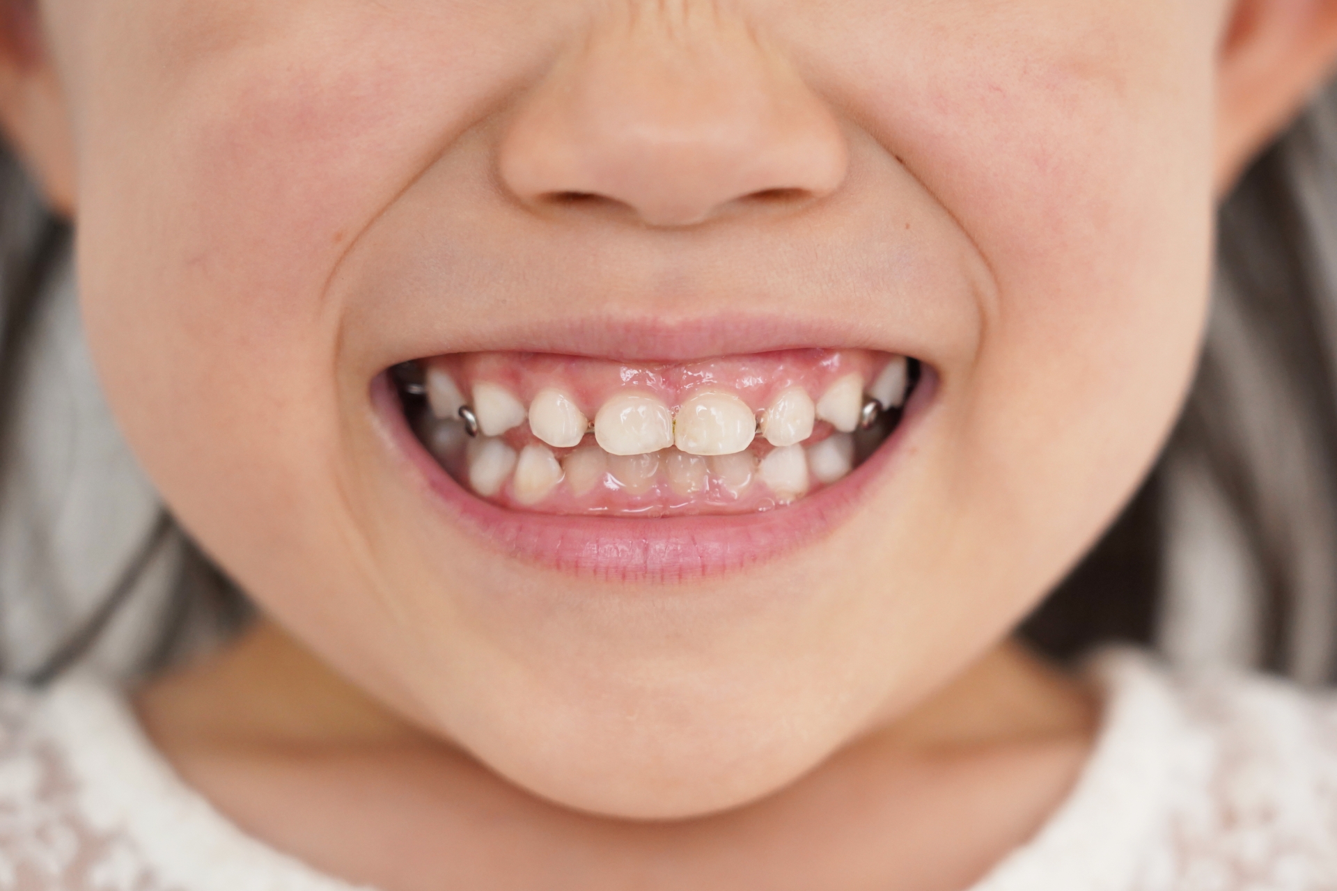 子供の歯の形成不全とは？ふくおか歯科が解説 | 医療法人真心会