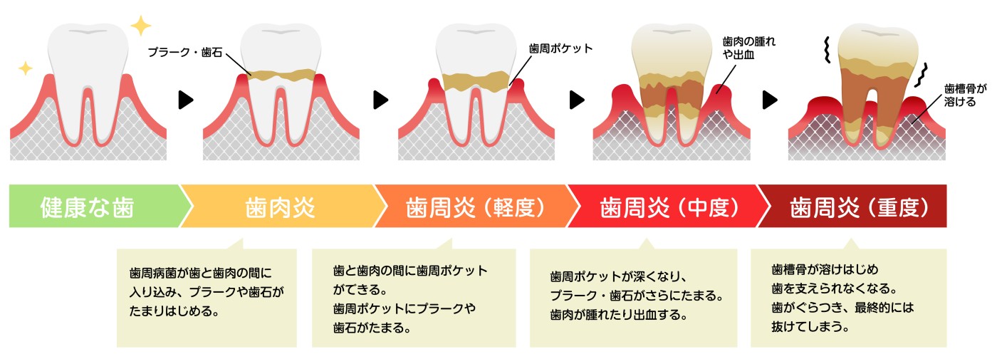 歯周病の進行