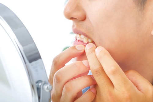 恐ろしい病気歯周病